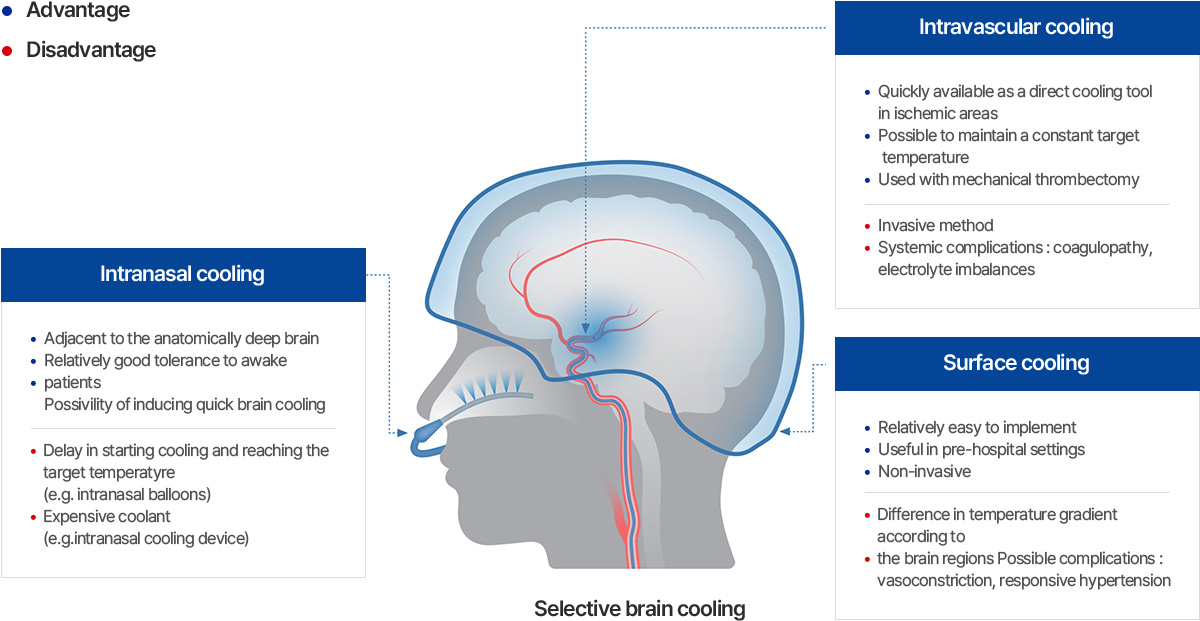 Nasal Selective Brain Cooling Technology image